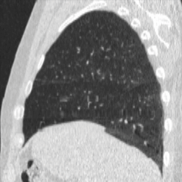 File:Spiral 4DCT Lung (Lateral).gif