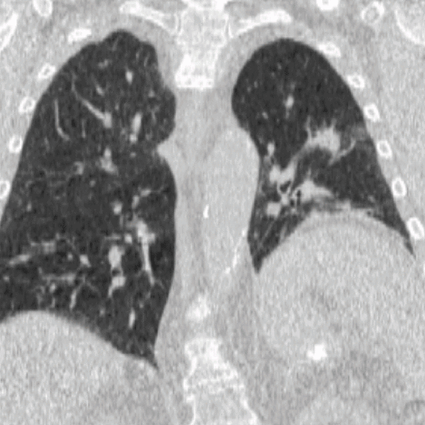 File:Spiral 4DCT Lung (Post).gif